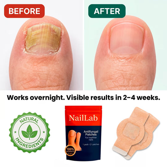 NailLab™ — Fungal Nail Patches